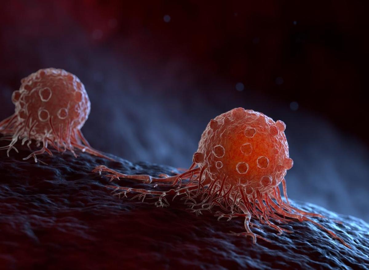 Glioblastome : stresser les cellules cancéreuses pour aider les tuer