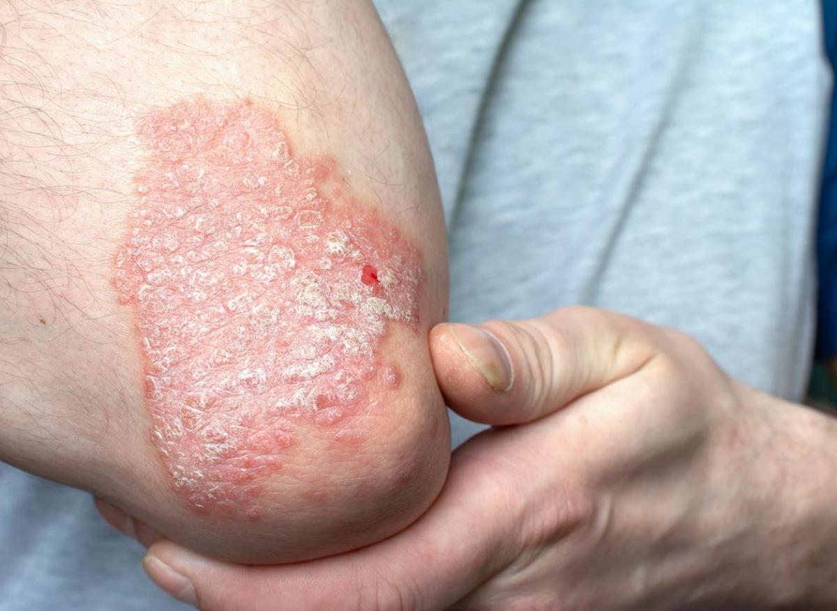 Psoriasis : un handicap et encore beaucoup d'idées reçues