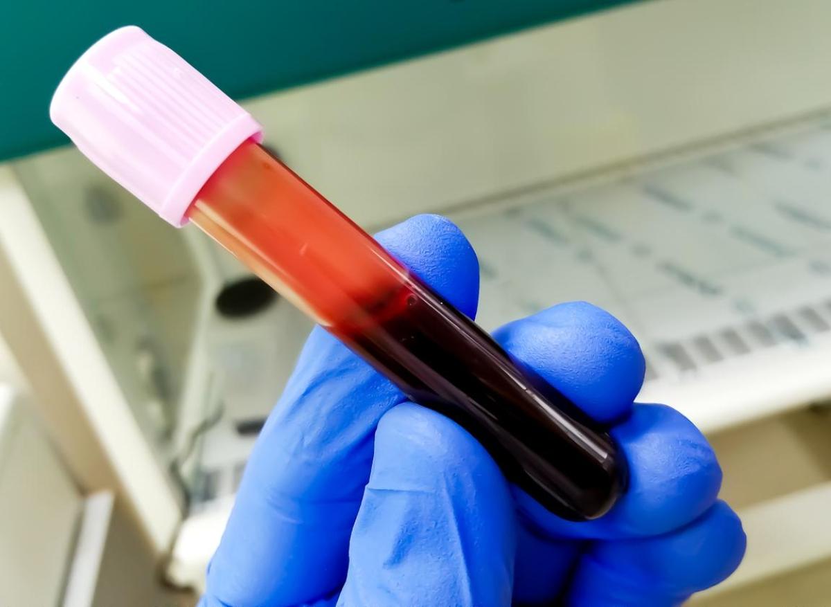 Trouble bipolaire : mise au point d'un test diagnostique sanguin