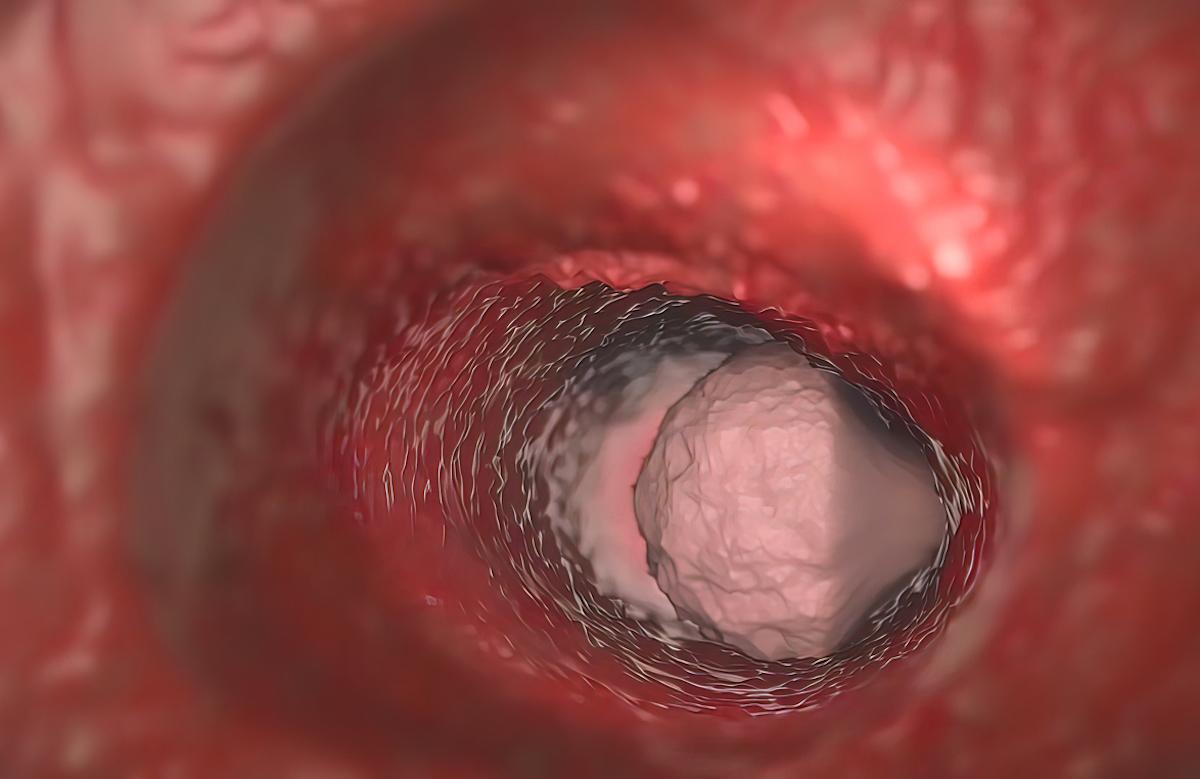 Cancer du côlon et instabilité microsatellitaire : intérêt de l’immunothérapie néoadjuvante