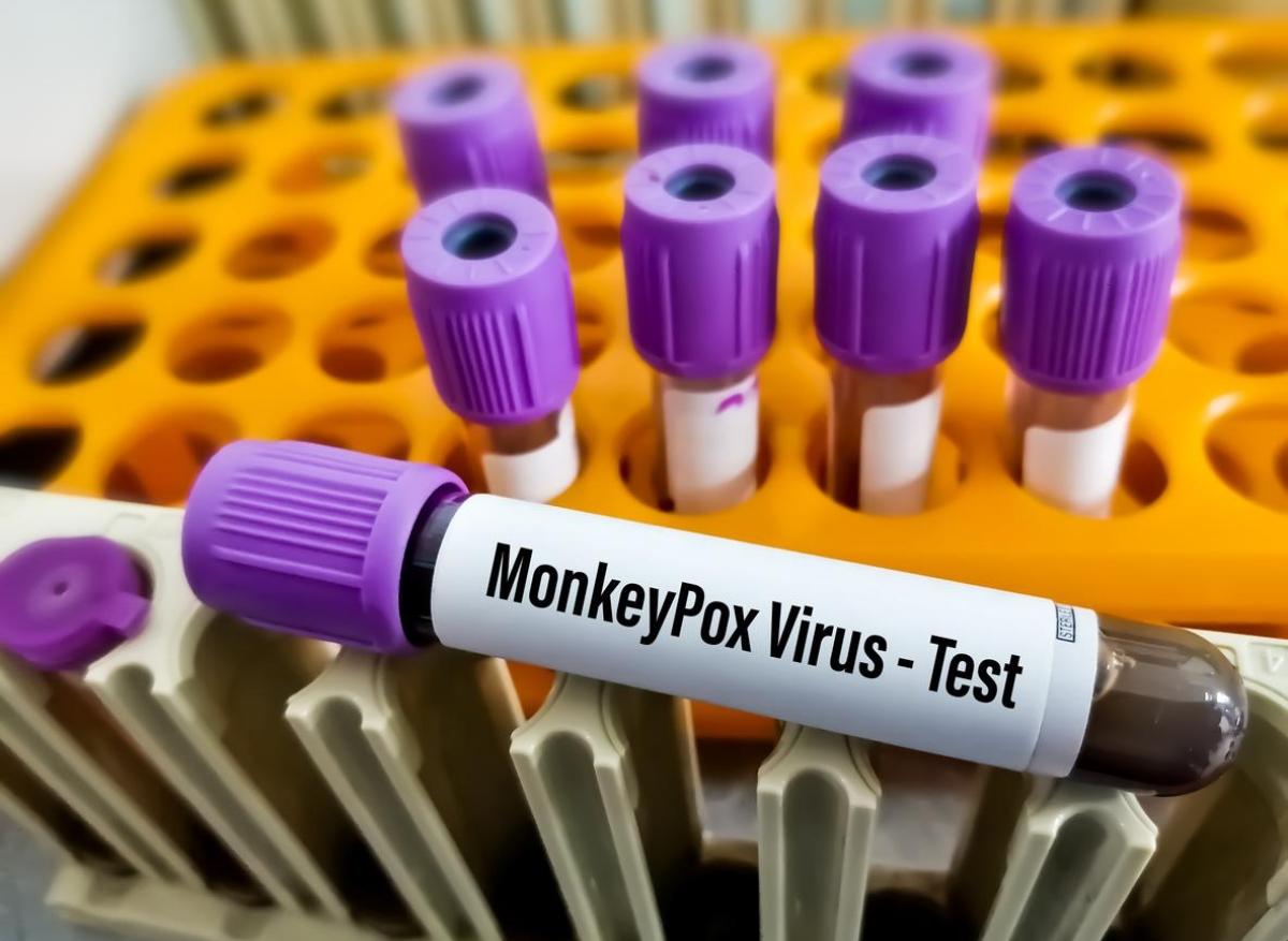 Variole du singe : les tests de dépistage remboursés à 100% 