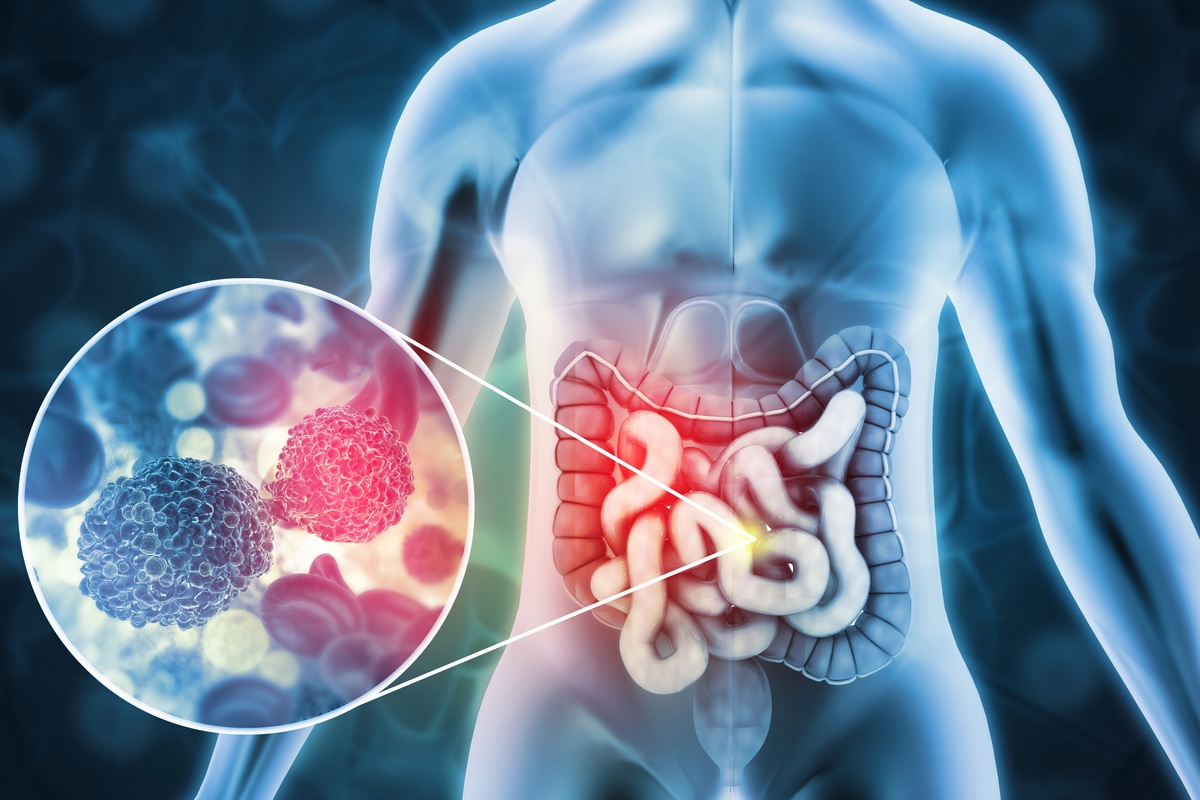 Cancer du colon : le potentiel de la biopsie liquide dans la stratégie thérapeutique