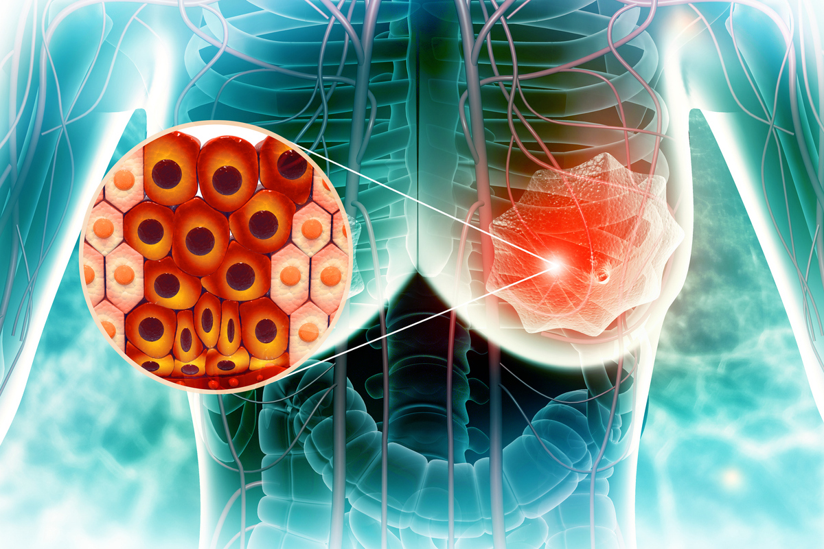 Cancer du sein : Inhibiteur de CDK4/6 en adjuvant, au tour du ribociclib