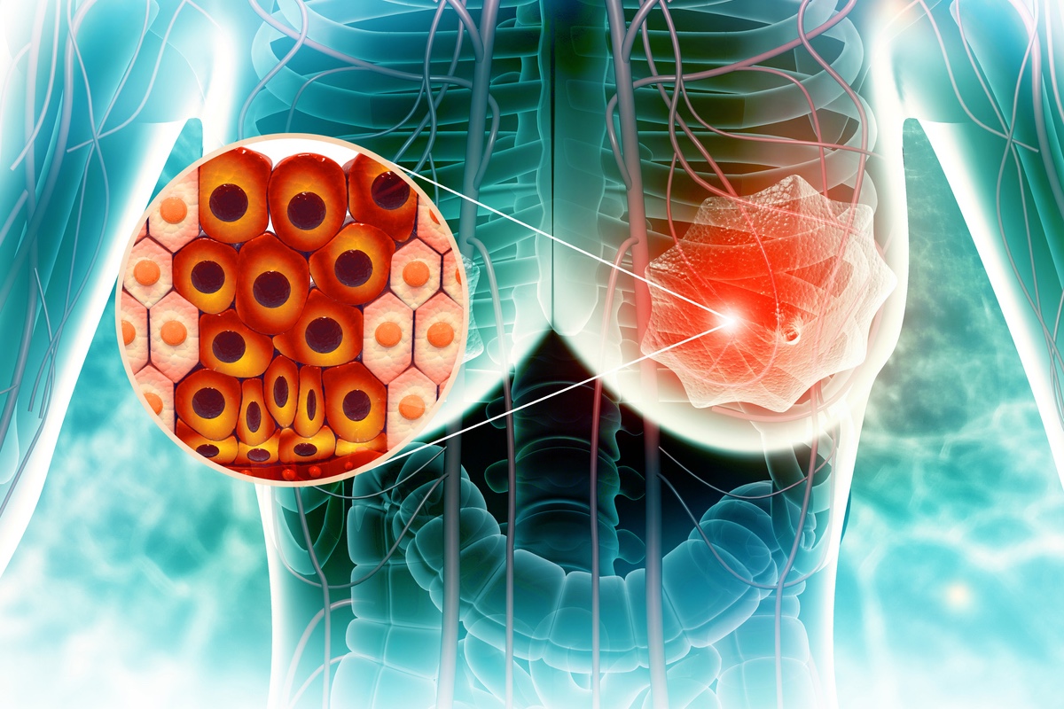 Cancer du sein HER+ : le Carboplatine a-t-il encore une place en néoadjuvant ?