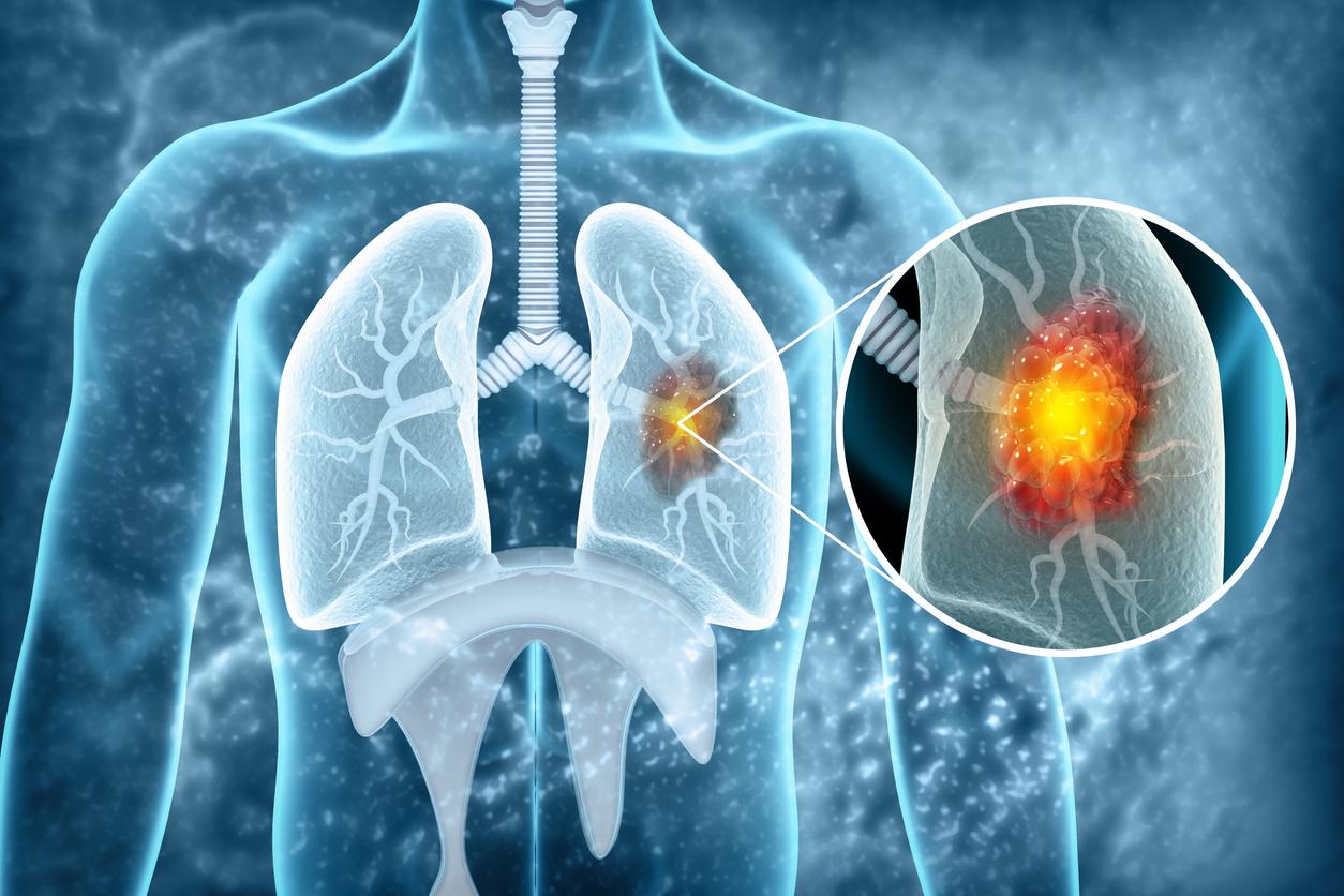 Cancer bronchique : une réponse dans plus de 30% des cas avec le daraxonrasib 