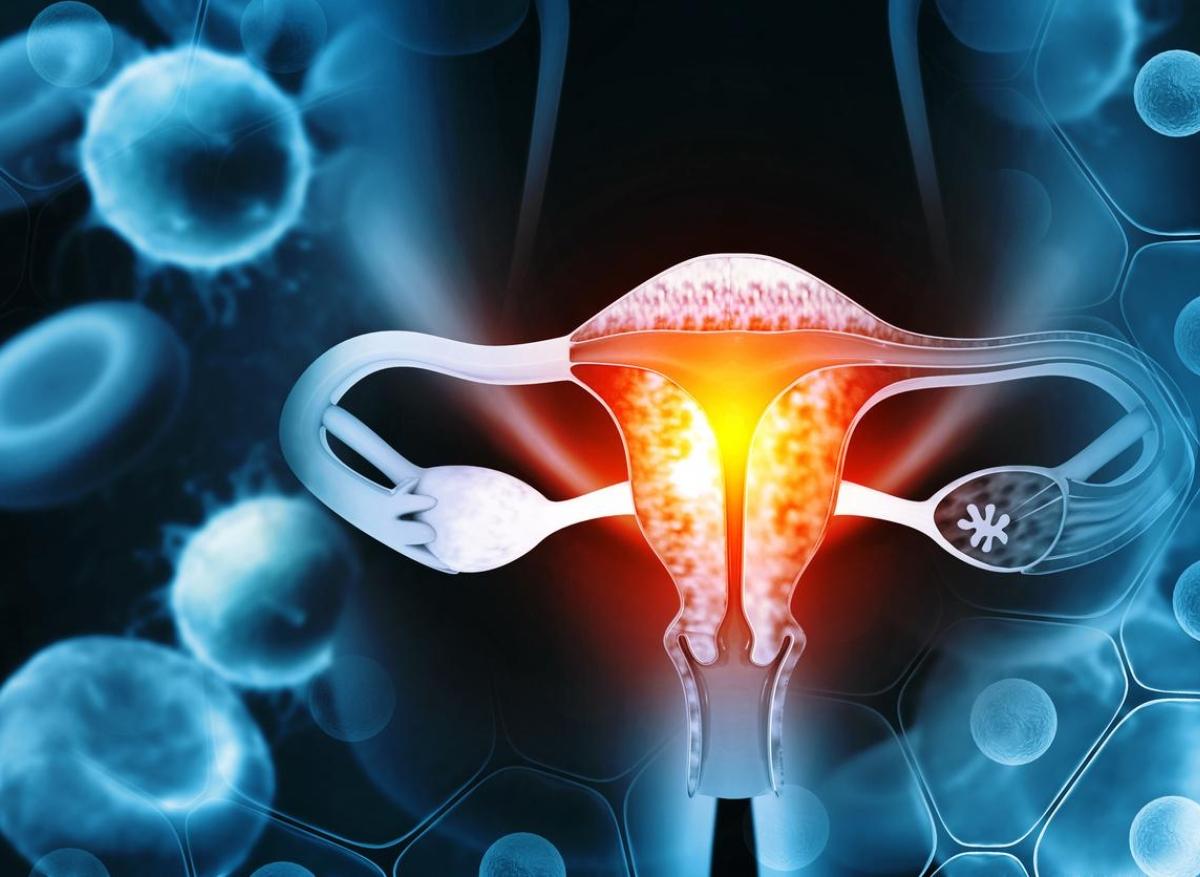 Cancer du col de l'utérus : retirer les lésions précancéreuses réduit les risques