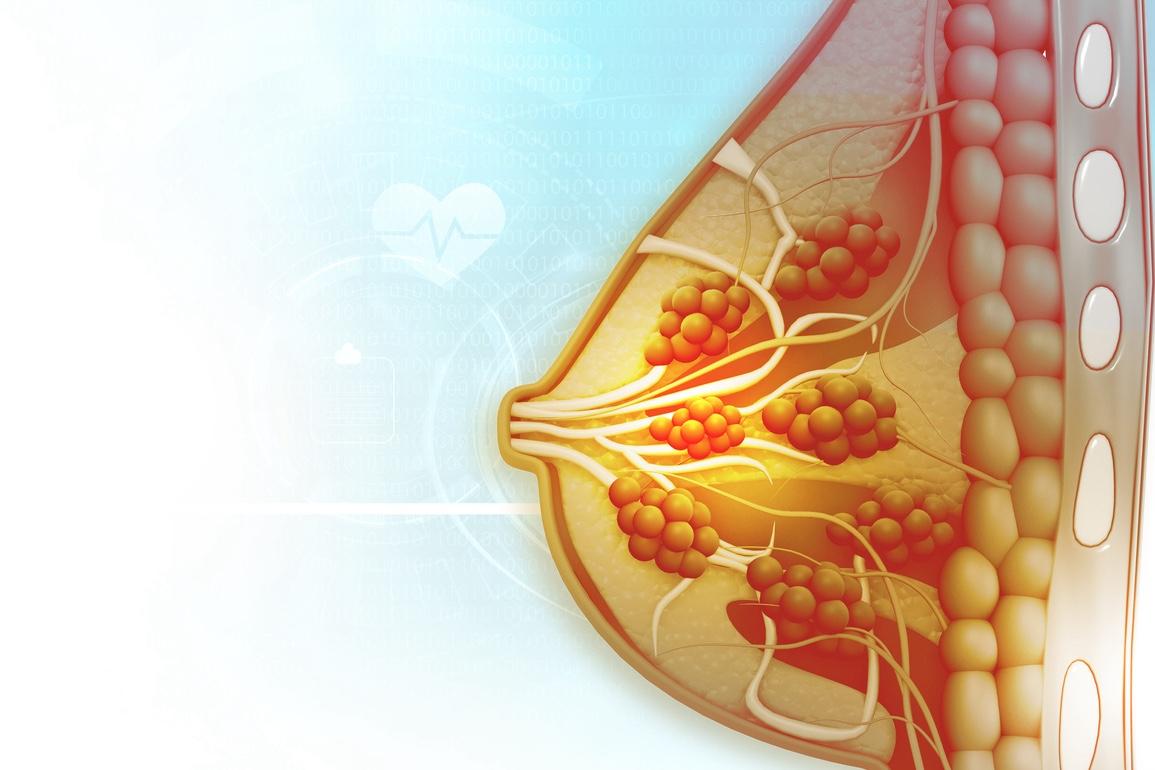 Cancer du sein métastatique RH+ HER2- : l'étude CAPITELLO propose une nouvelle association