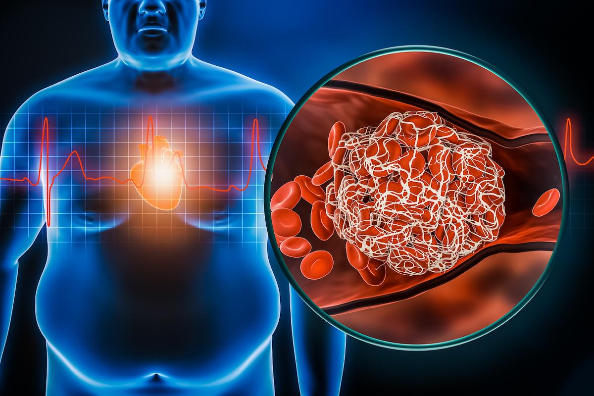 Fibrillation atriale : impact de l’obésité et de son risque métabolique sur le pronostic