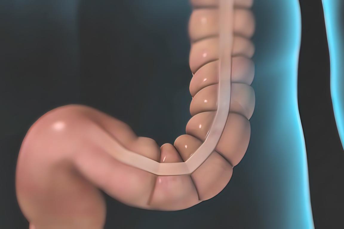 Cancer colorectal métastatique : pas de nouveau traitement en 1ère ligne