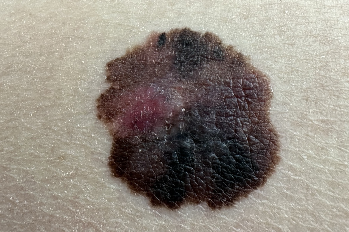 Mélanomes de stade II B et II C : confirmation des bénéfices du Pembrolizumab en adjuvant