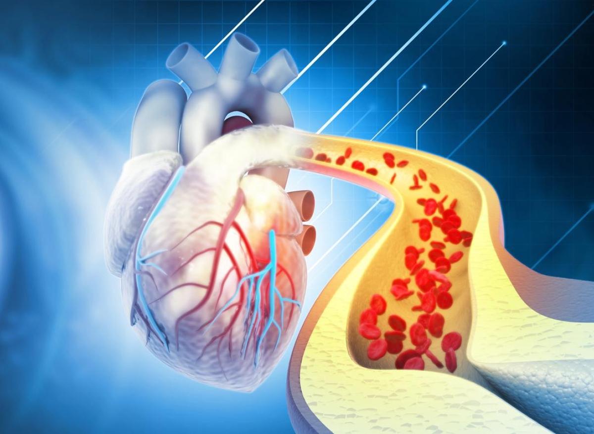 Hypercholestérolémie : l'analyse génétique prédit mieux les risques cardiovasculaires