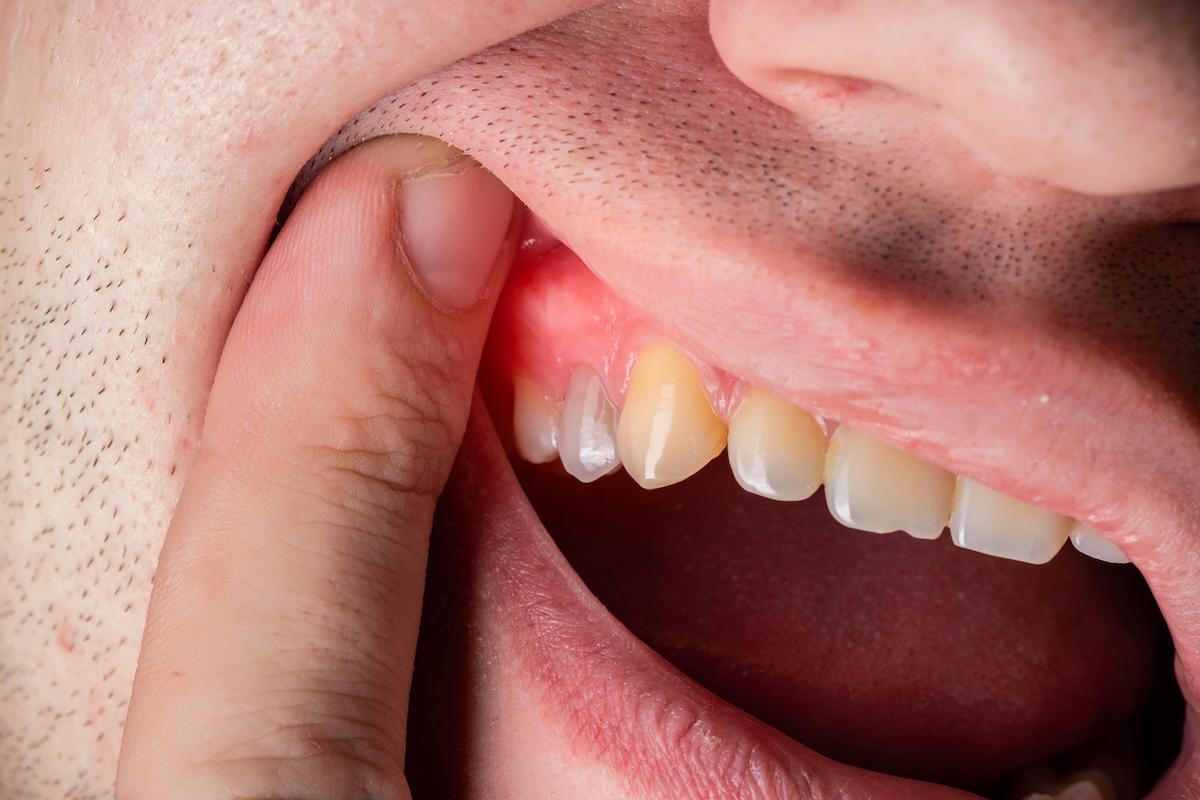 Parodontite : la 6ème complication du diabète nécessite des consultations dentaires régulières 