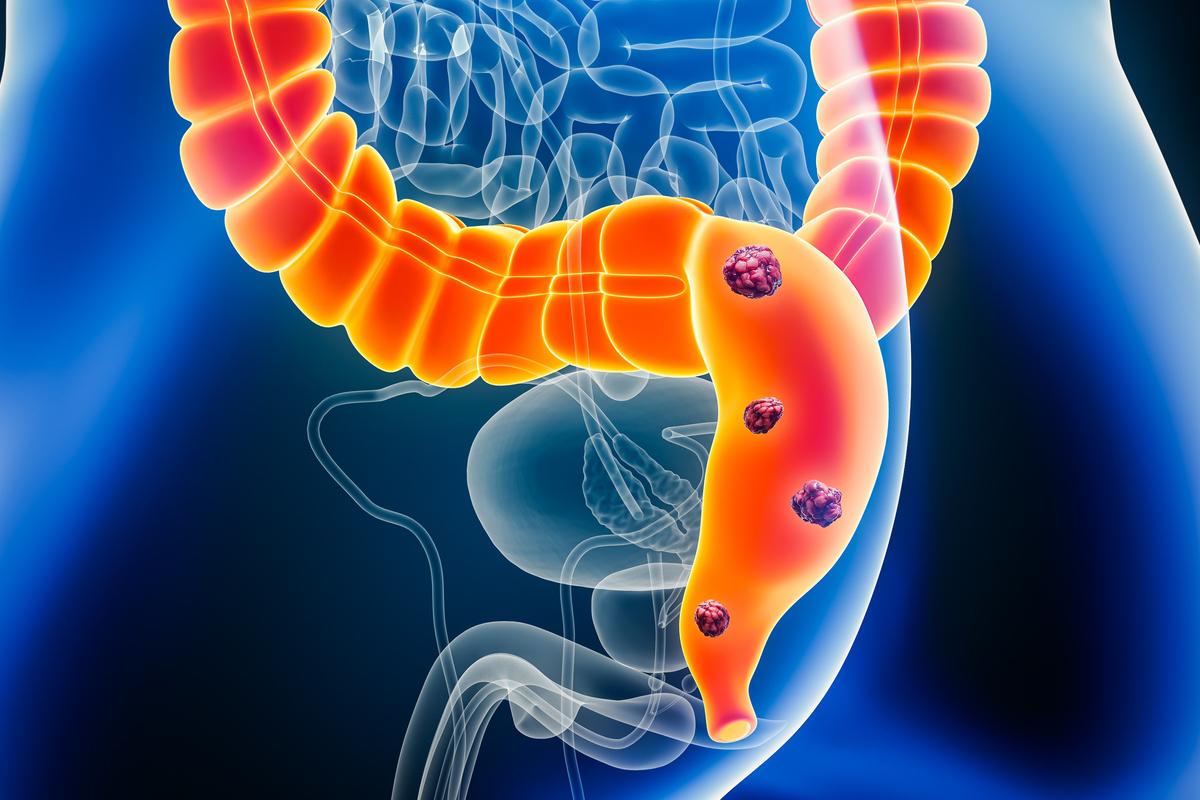 Cancers colorectaux pMMR : immunoscore & immunothérapie