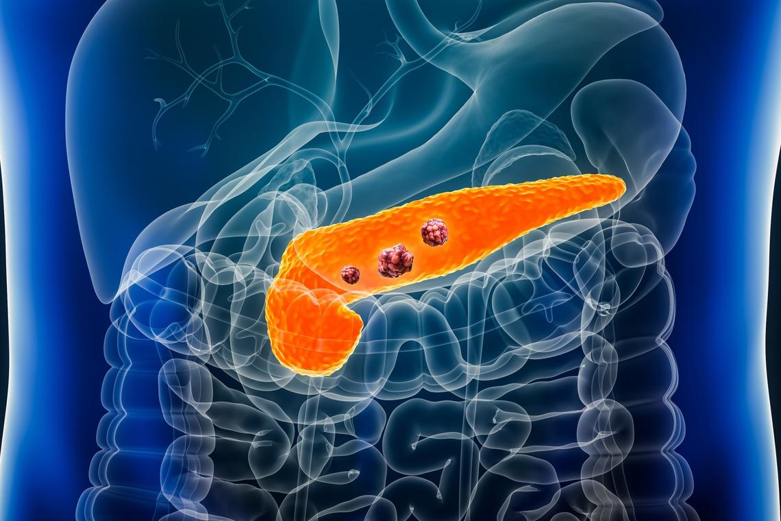 Adénocarcinome du pancréas métastatique : une SEQUENCE intéressante ?