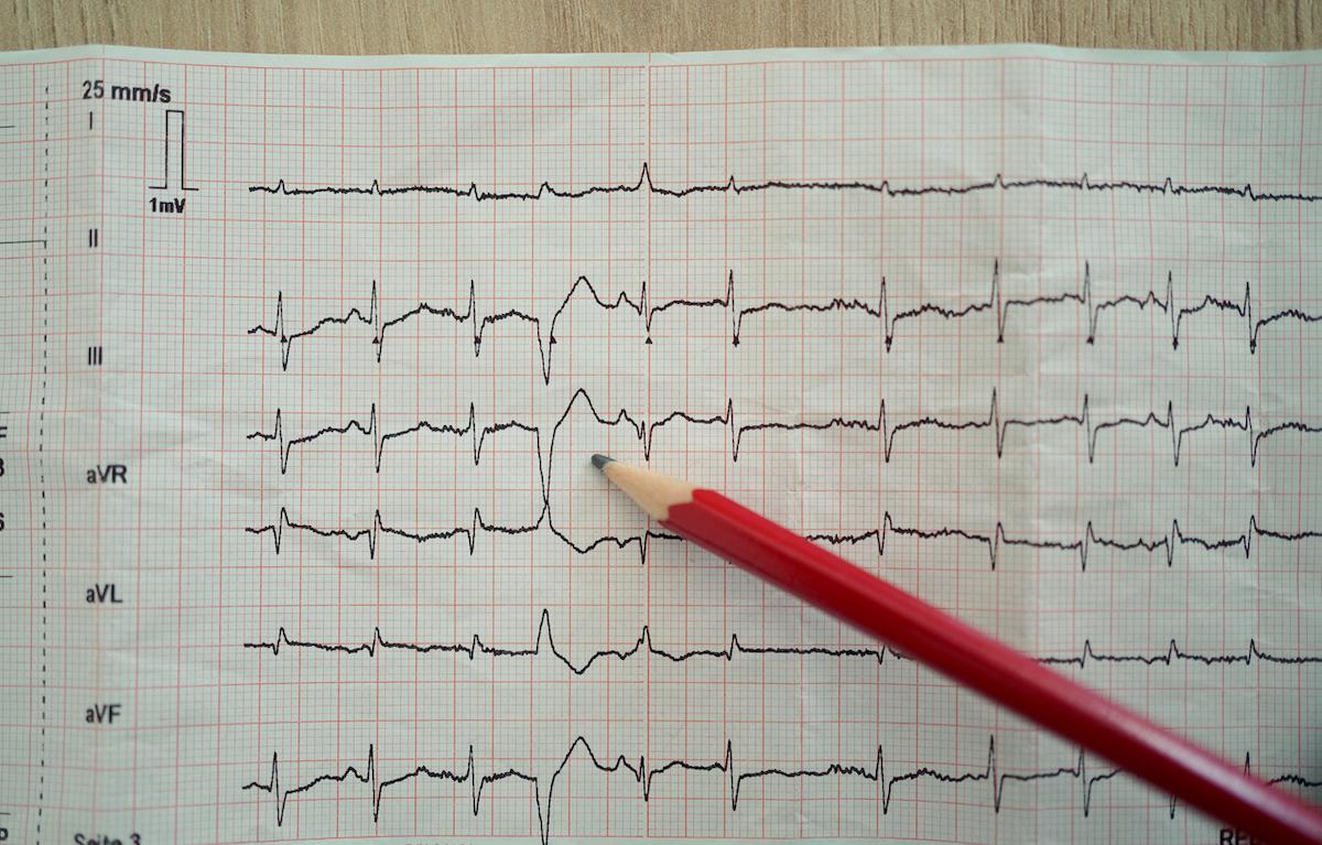 Arythmie cardiaque : le café associé à plus d’extrasystoles ventriculaires ?