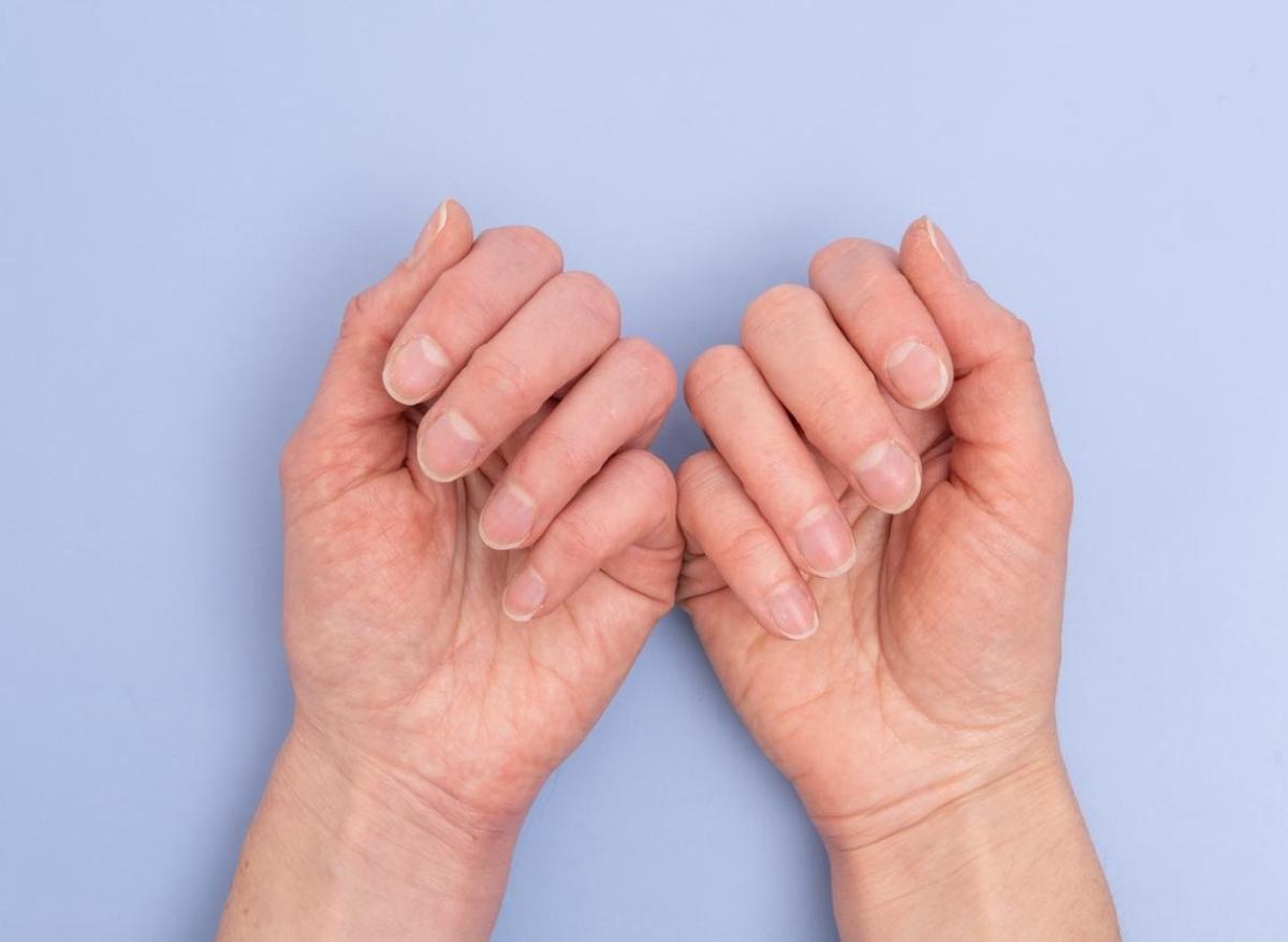 Cancer : un onychopapillome de l'ongle lié à une hausse des risques