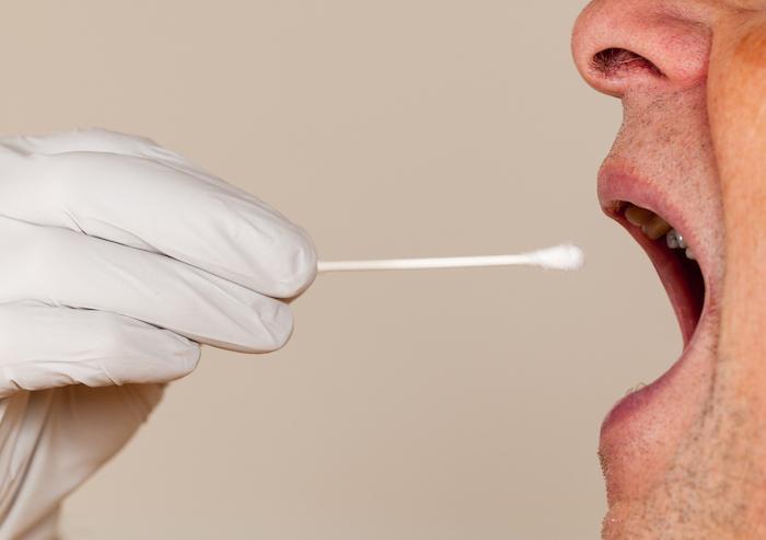 Cancer de la prostate : un test salivaire pour repérer les patients à risque ? 