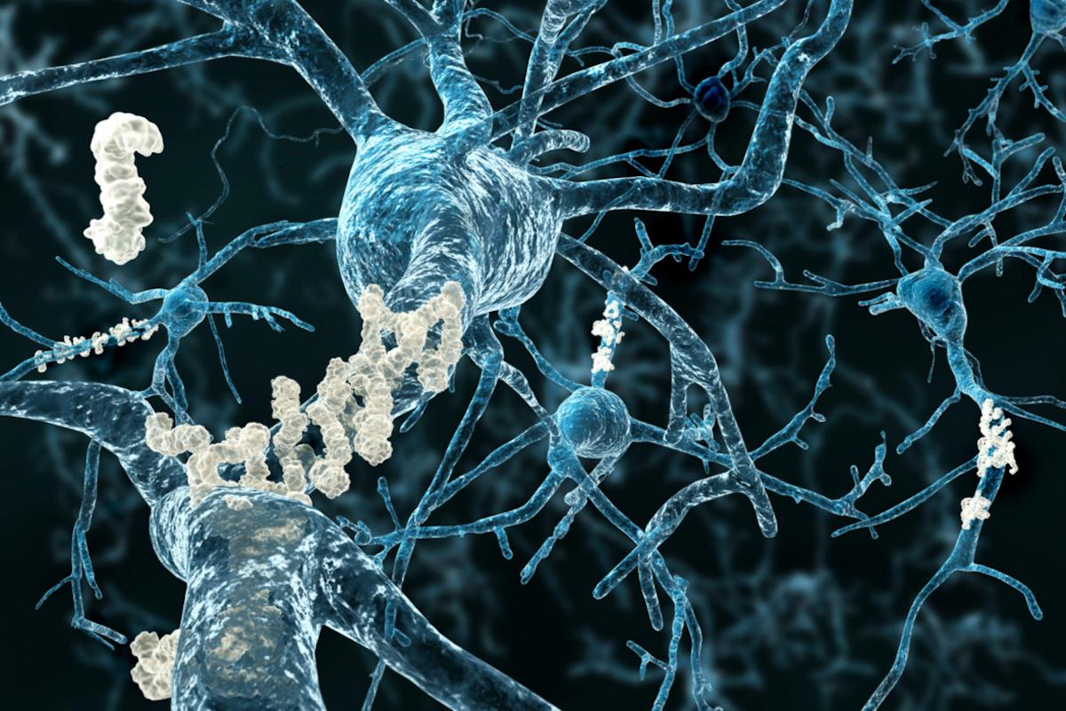 Alzheimer : un nouvel anticorps anti-amyloïde marcherait dans les formes précoces