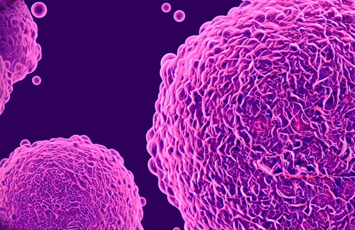 Lymphome de Hodgkin du sujet âgé : le Nivolumab surclasse le BV en première ligne !