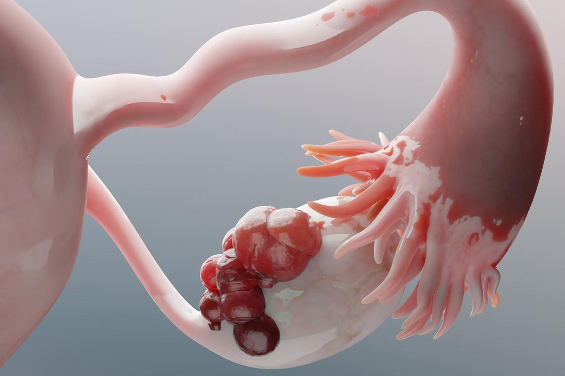 Cancer de l'ovaire : l'immunothérapie ne passe toujours pas !