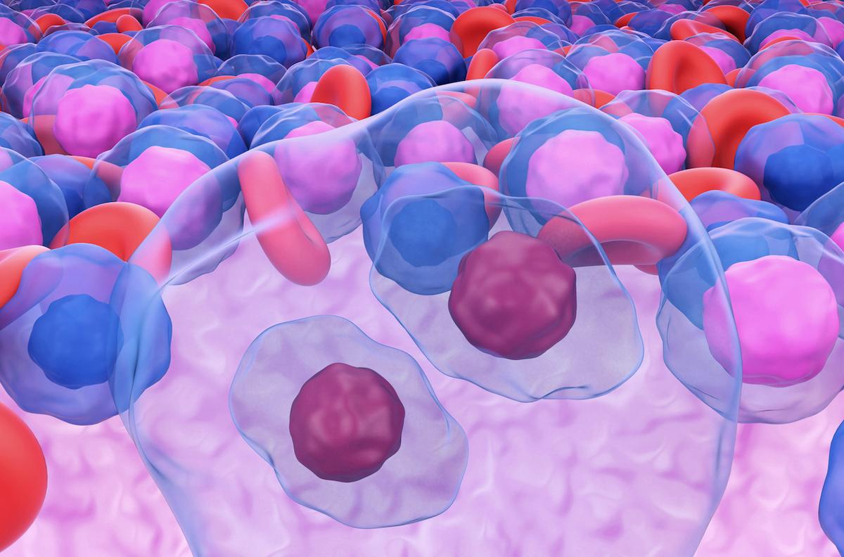 Maladie de Hodgkin avancée : le BrECADD plus efficace et mieux toléré que le BEACOPP