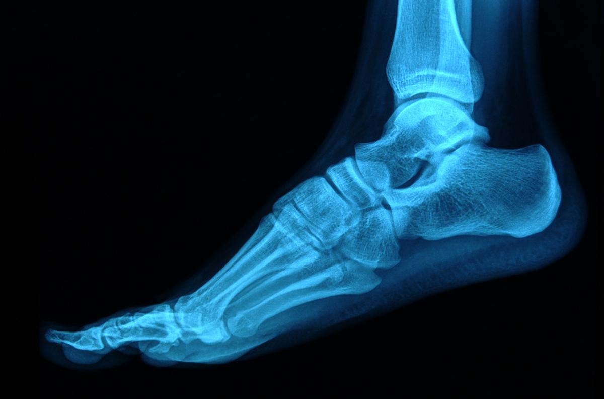 Douleur-piège du pied : le syndrome du canal tarsien est souvent diagnostiqué tard