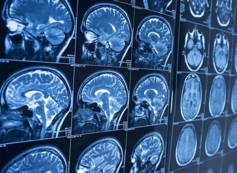 Neurocysticercose : une fausse tumeur comme un « œuf de caille » dans le cerveau