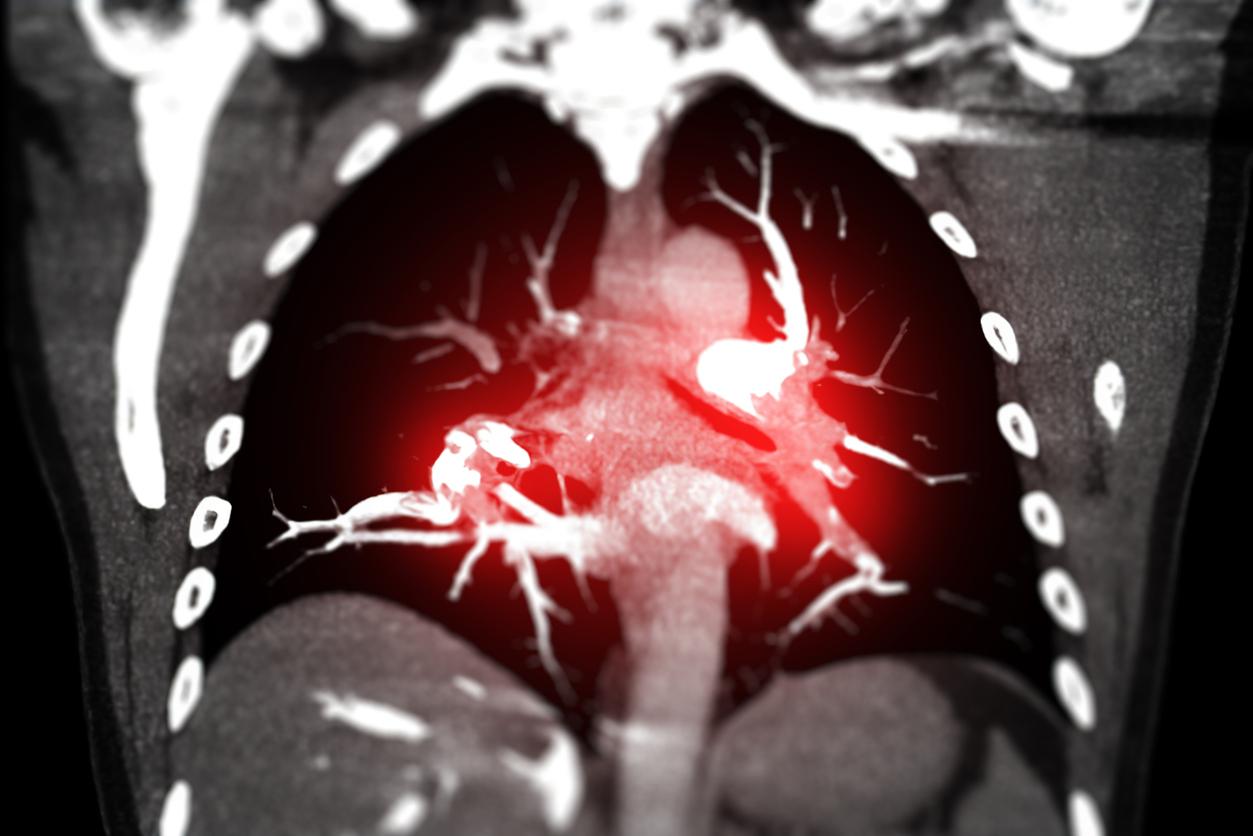 Embolie pulmonaire : l'algorithme YEARS plus performant que l'angioscanner pulmonaire