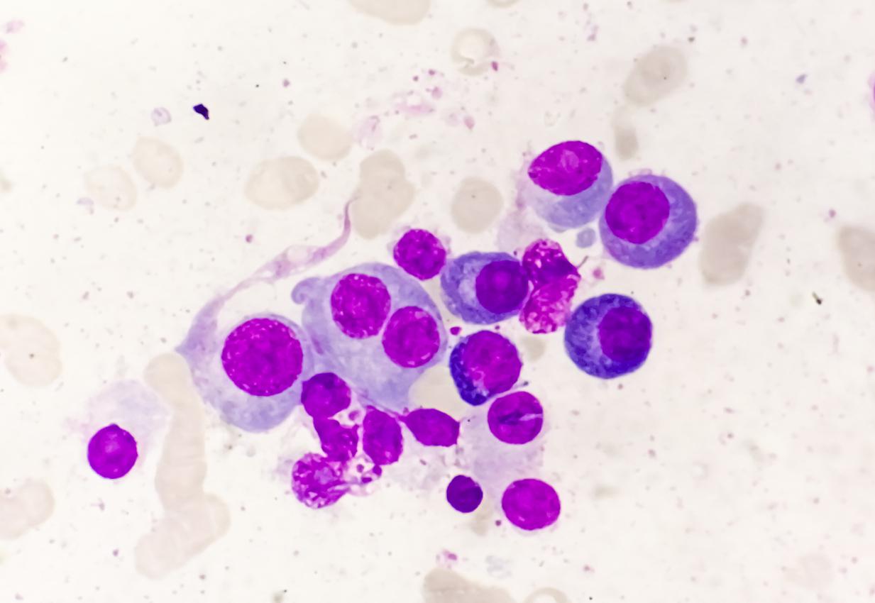 Myélome multiple asymptomatique : faut-il envisager un traitement par CAR-T ? 