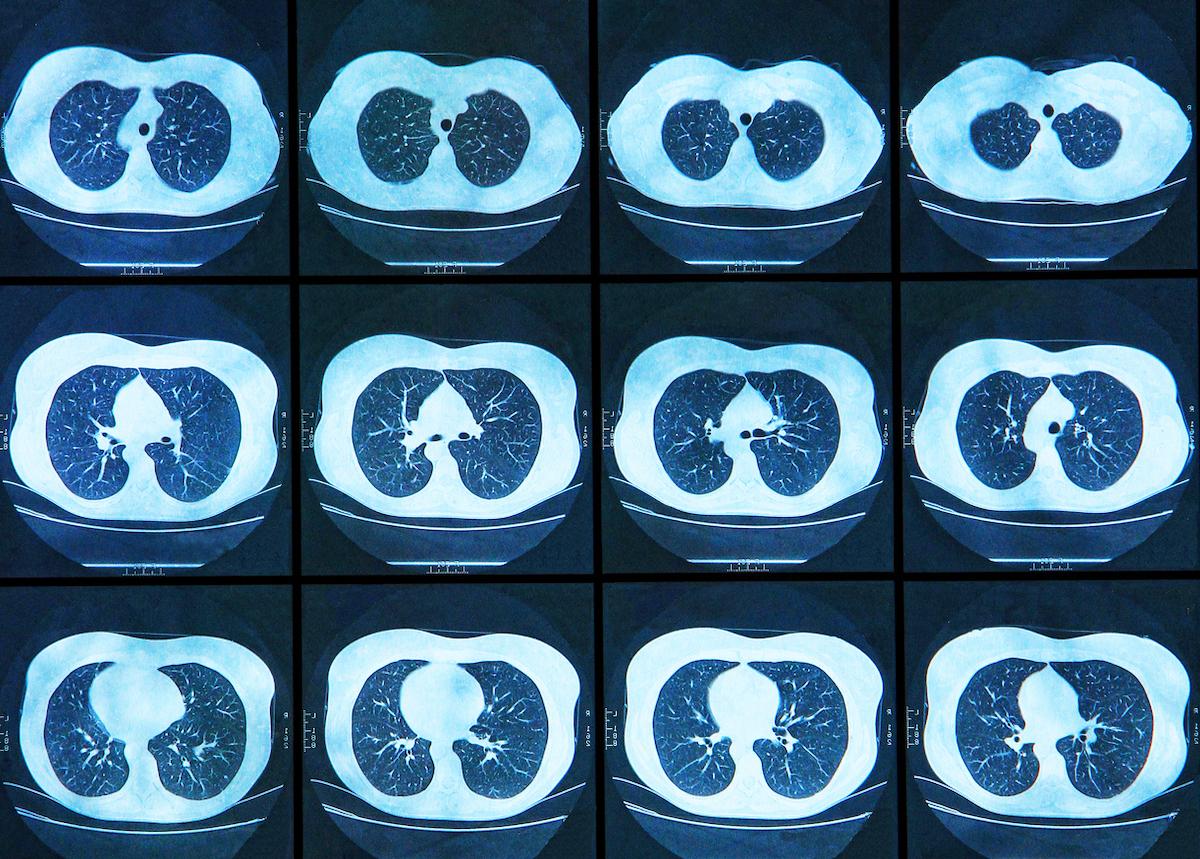 CBNPC en néoadjuvant : intérêt de l’immunothérapie associée à la radiothérapie stéréotaxique