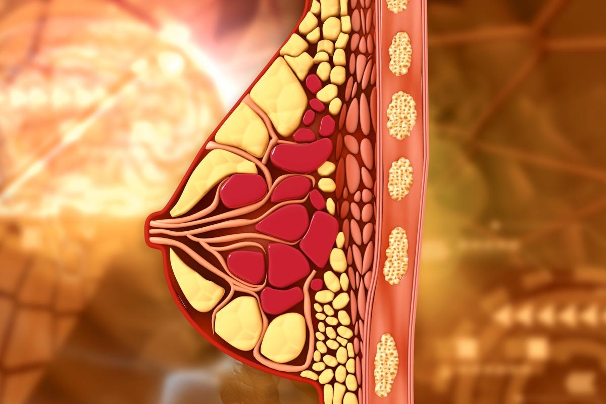 Cancer du sein triple négatif : NeoPACT, un schéma sans anthracycline 