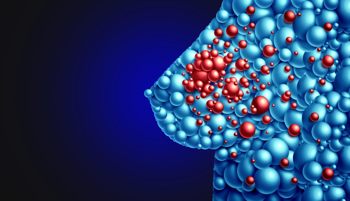 Cancer du sein ERBB2+ : une désescalade thérapeutique sûre grâce à un test d'ADN circulant ultra sensible