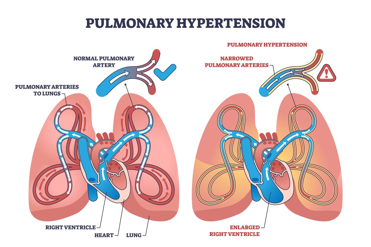 Hypertension artérielle pulmonaire : un nouveau traitement  réduit de 76% le risque d'évènement grave 