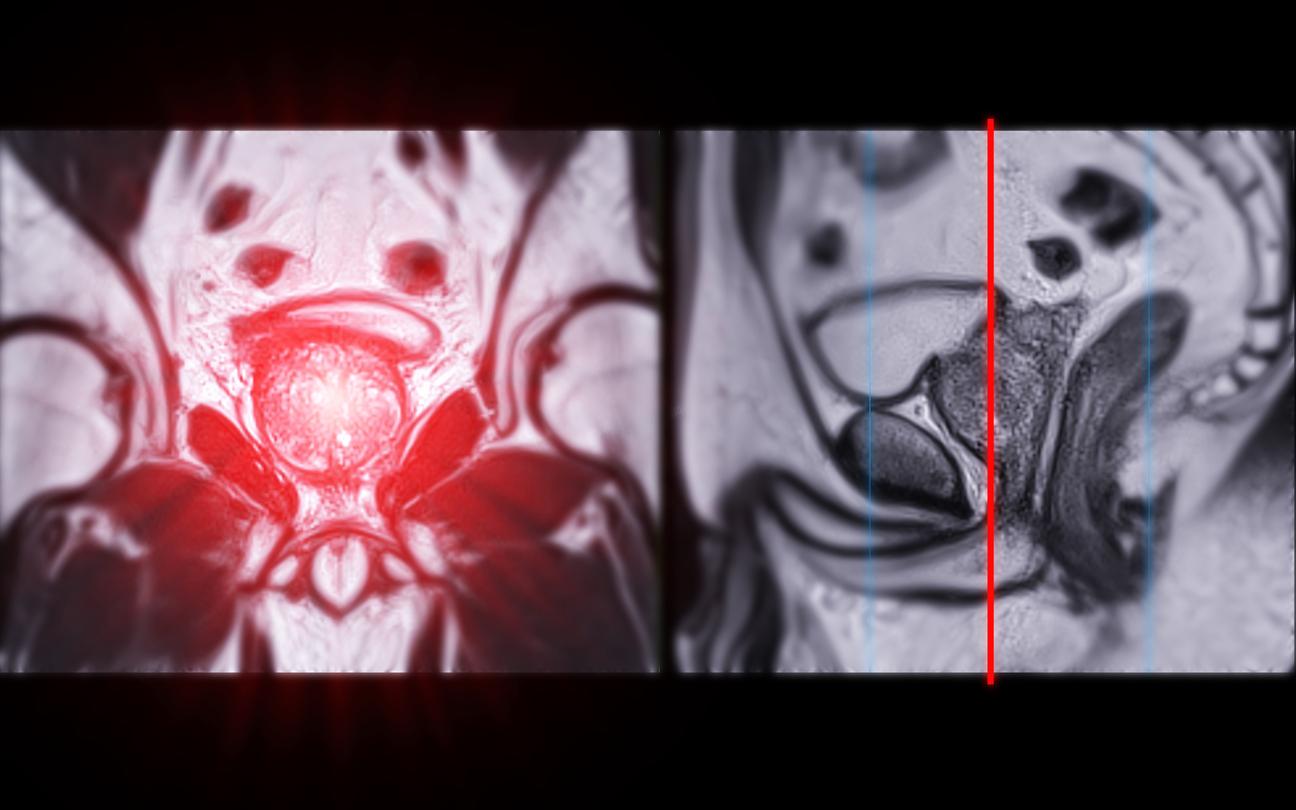 Cancer de la prostate : vers la fin de l'hormonothérapie pour tous les patients après radiothérapie 