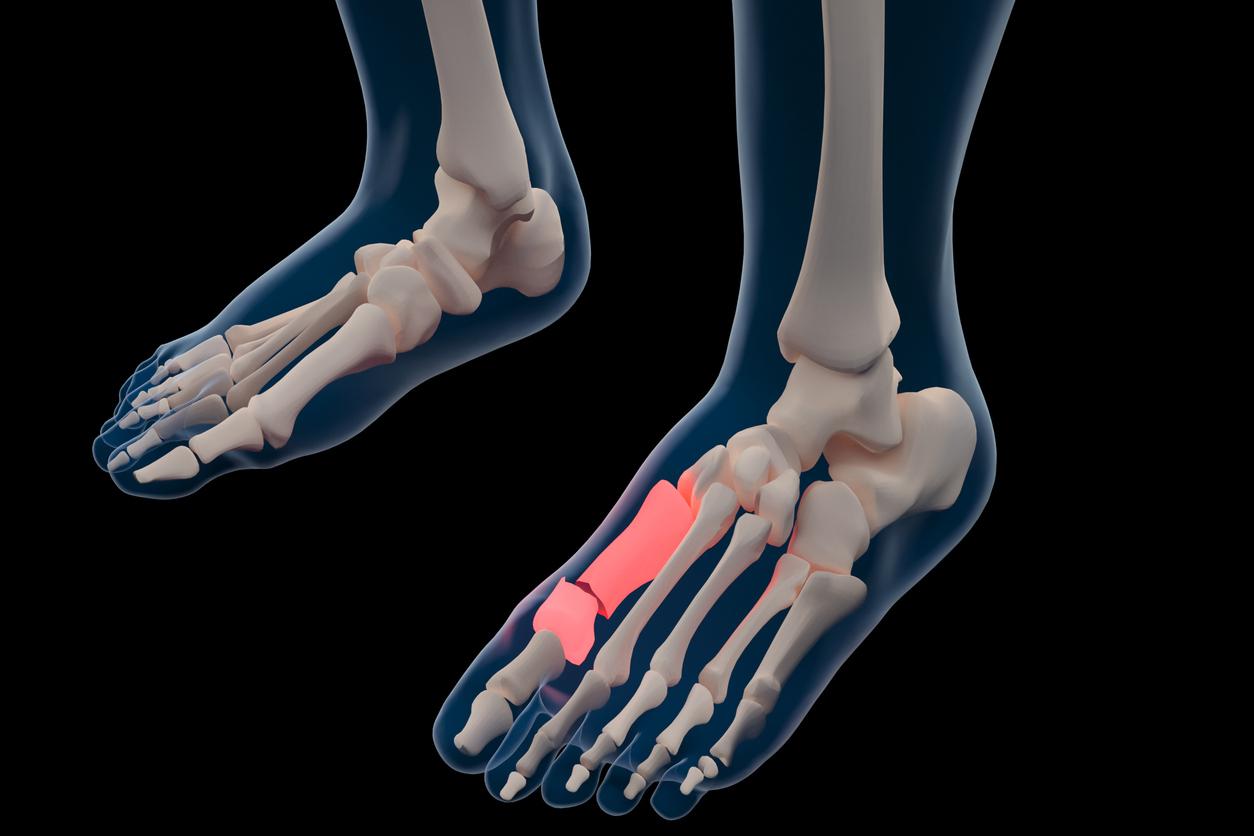 Hallux rigidus : privilégier l'arthrodèse plutôt que la simple surveillance