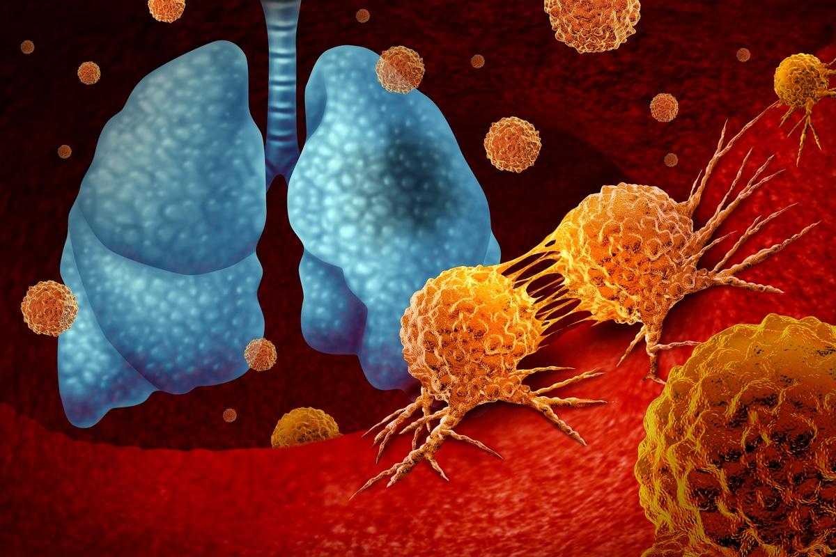 Adénocarcinome pulmonaire muté KRAS : l’importance de l’axe ISR-ATF4