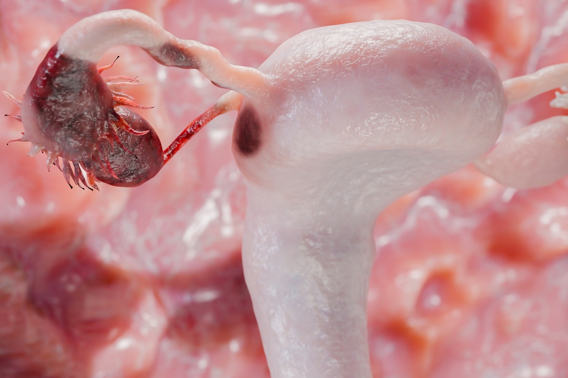 Cancer de l'ovaire platine résistant : analyse définitivement négative pour l'Atezolizumab !