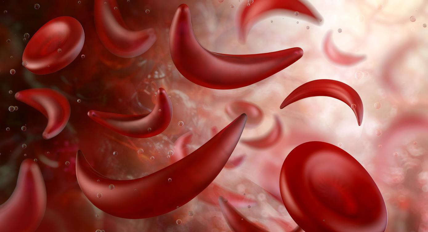 Drépanocytose : la thérapie cellulaire efficace dans une population pédiatrique