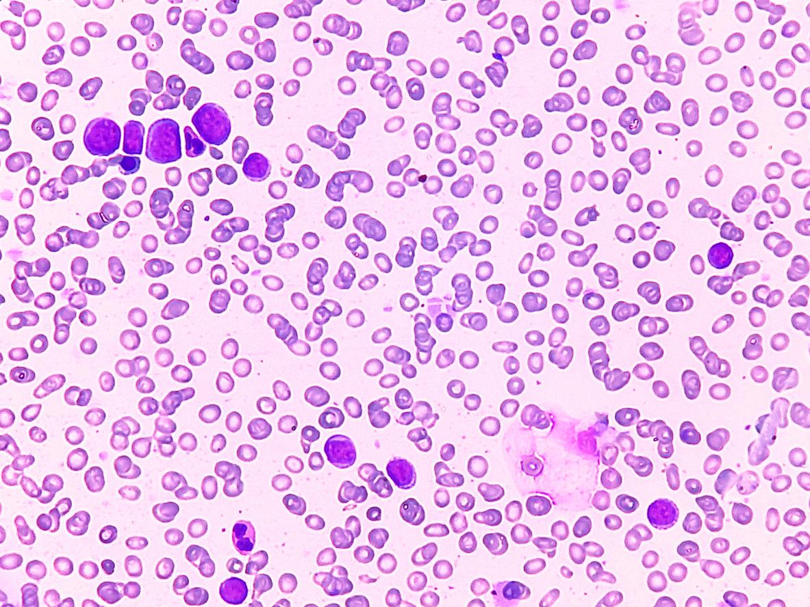 Leucémie aiguë myéloïde : un nouvel essai français pour les patients en échec thérapeutique 