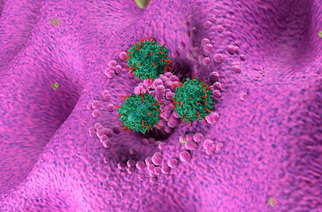 Adénocarcinome gastrique : 1ère AMM mondiale pour un CAR-T ... en Chine  
