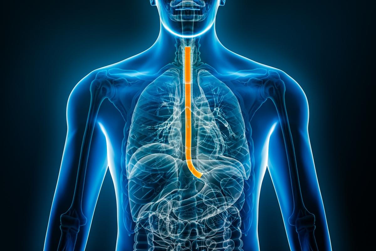 Carcinome épidermoïde de l'oesophage métastique : l'ajout d'un anti-VEGF a-t-il un intérêt ?
