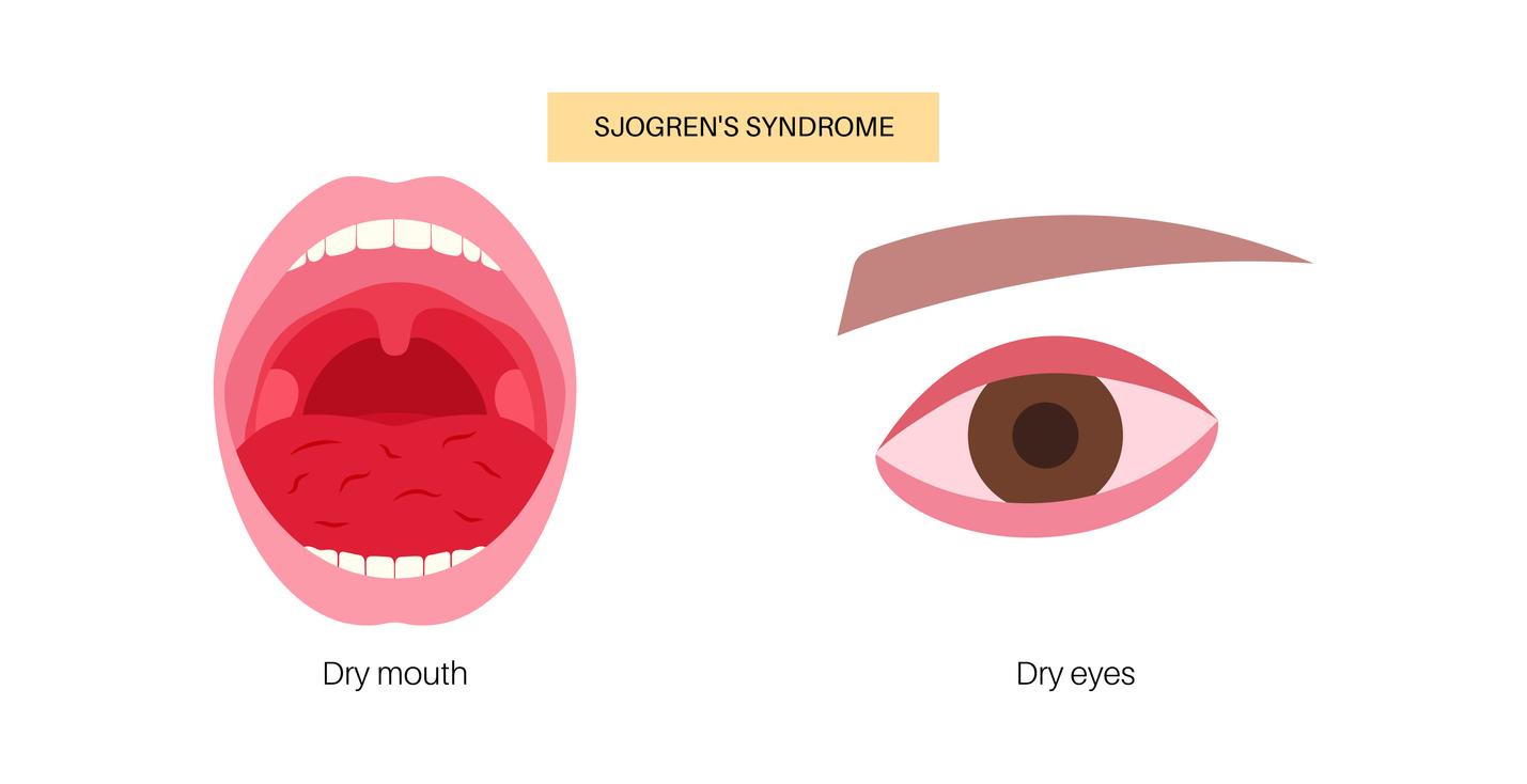 Syndrome de Sjögren : un signal d'activité pour une thérapie ciblée mais pas d'impact clinique