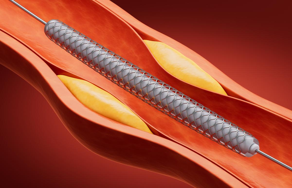 Infarctus du myocarde : peut-on raccourcir la double anti-agrégation ?