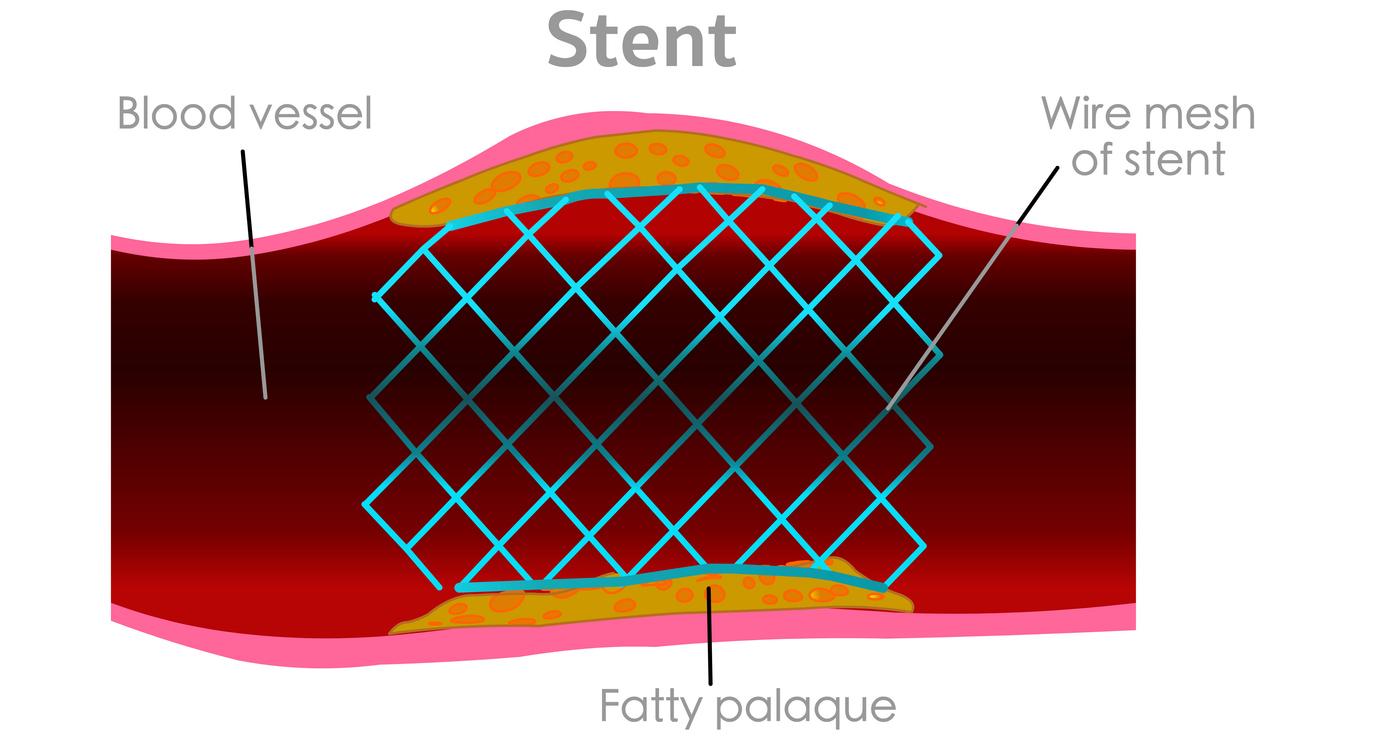 Angioplastie : faut-il prolonger la  bithérapie antiplaquettaire au-delà de 12 mois?  