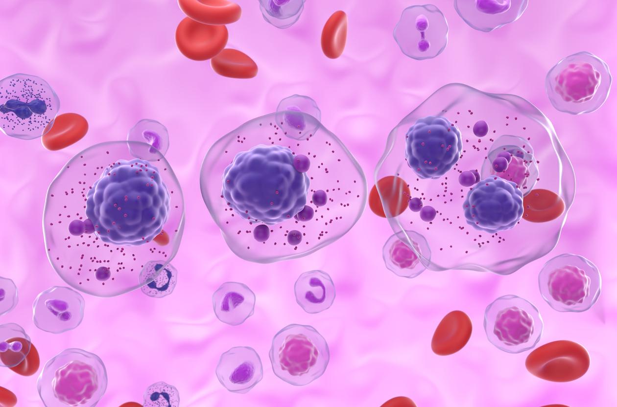 Myélome multiple réfractaire : le premier CAR-T in vivo à démontrer un taux de réponse de 100 %
