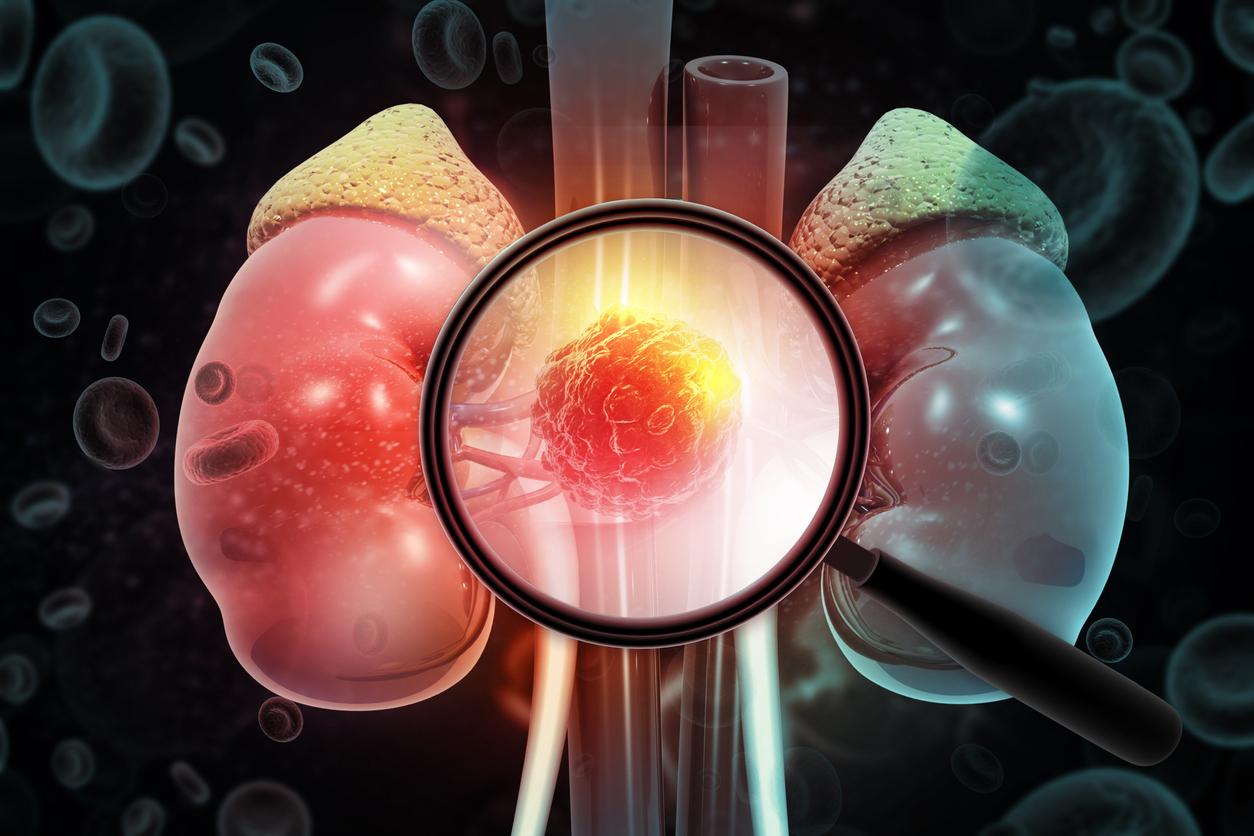 Carcinome rénal à cellules claires : l'association pembrolizumab-belzutifan réduit le risque de récidive 