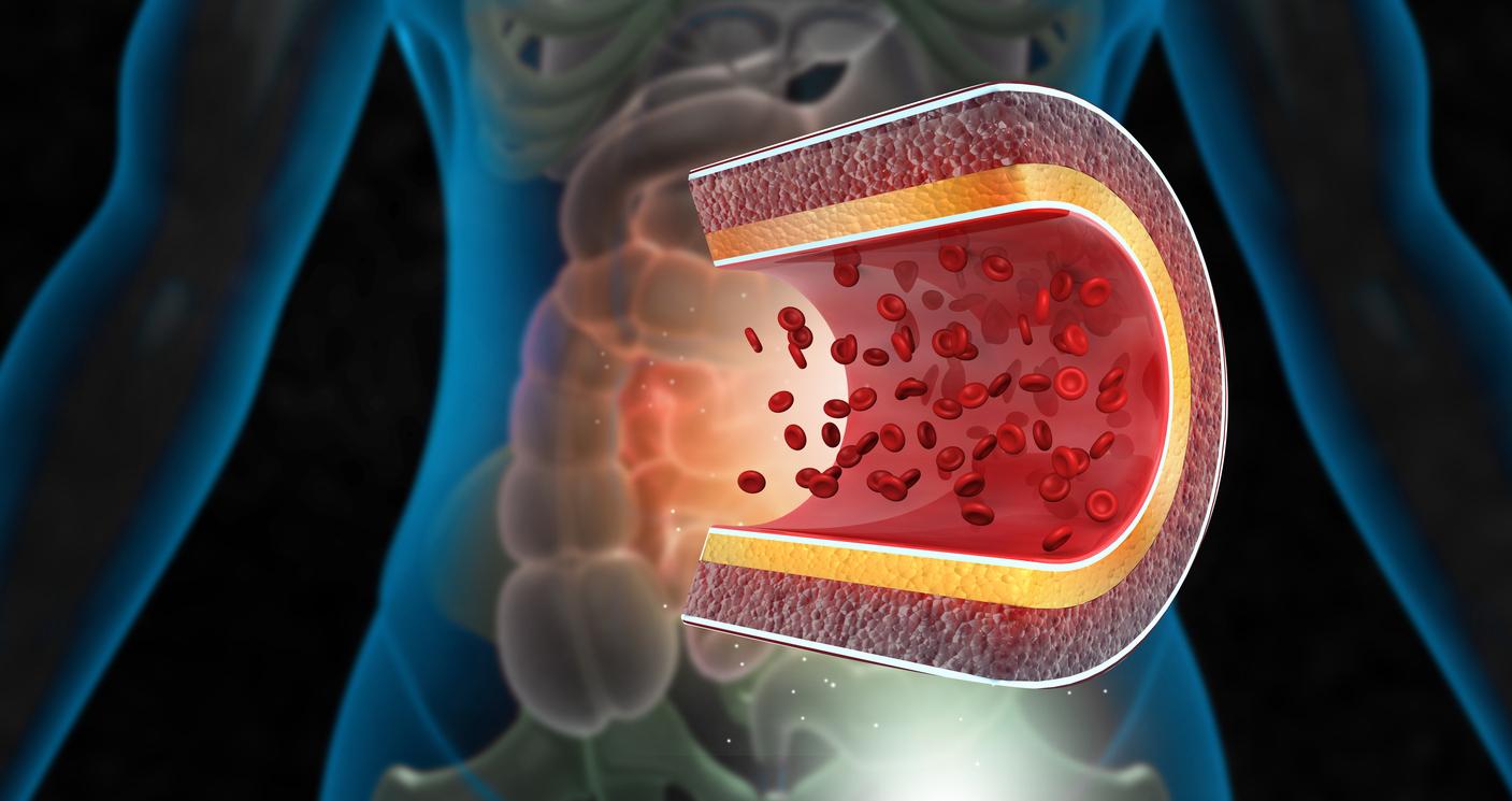 Hormones sexuelles : comment gérer en pratique le risque de thrombose 