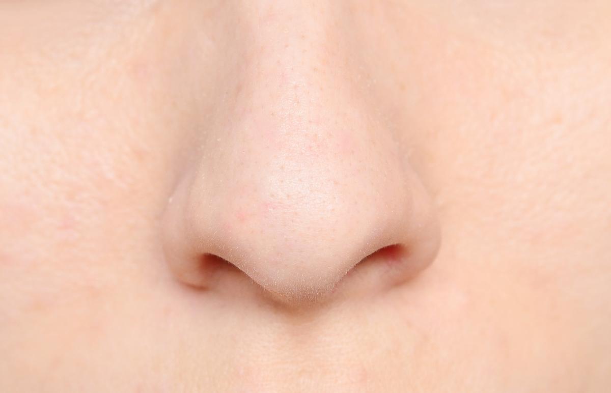 Syndrome du nez vide : des nouvelles recommandations HAS satisfaisantes