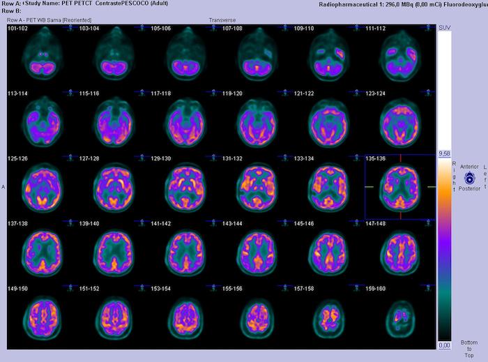 Dépression : un PET scan permet de prédire rapidement la réponse au traitement