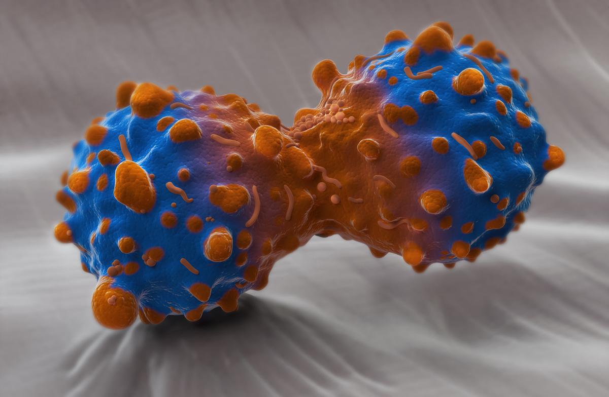 Cancer bronchique à petites cellules : 4 sous-groupes en analyse moléculaire 